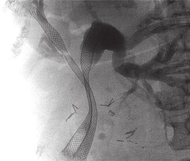 350 Hsieh et al. Wallflex TM stent in hilar biliary obstruction Figure 1 Fluoroscopic image of bilateral Wallflex TM UCSEMS at the hilum. performed for this series.