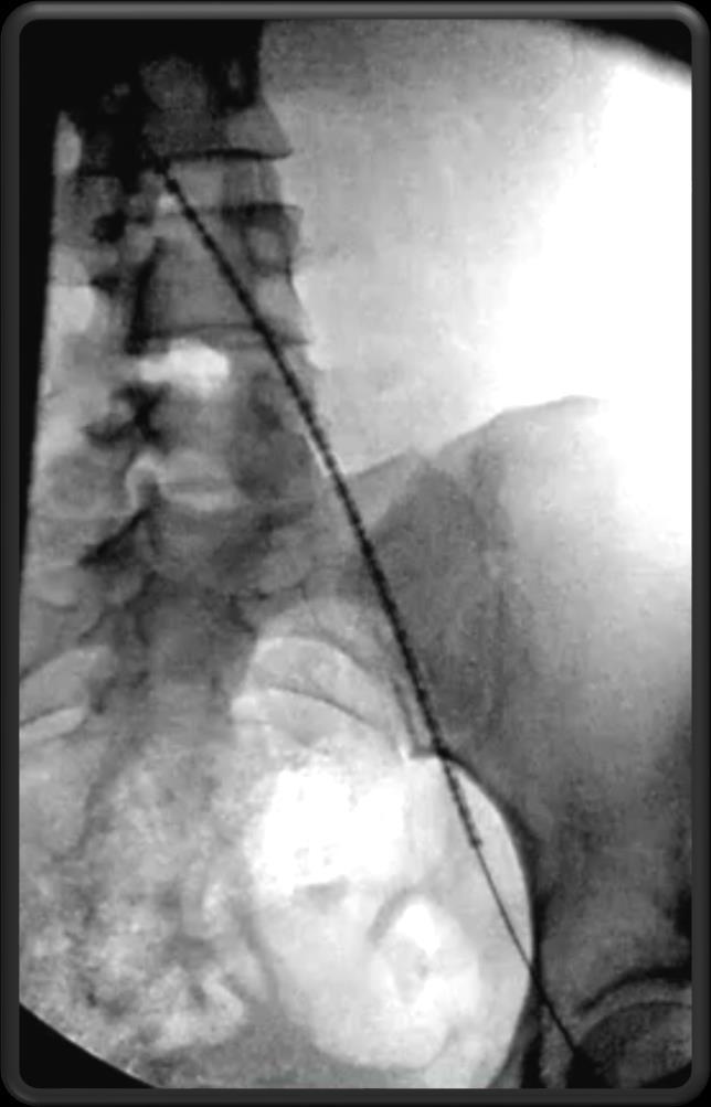 Stent Placement and Example of Post-stent Dilation Upper Stent This