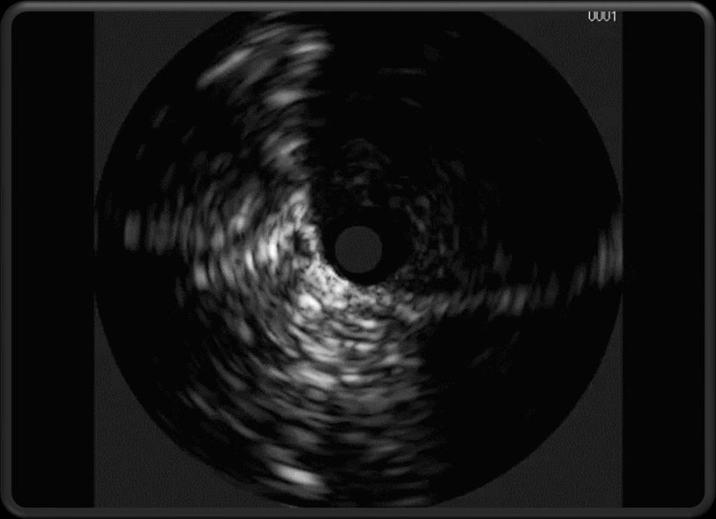 Intravascular Ultrasound (IVUS) Initial IVUS - (left