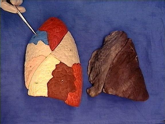 Segmental Anatomy of the Lungs 2 1 3 5