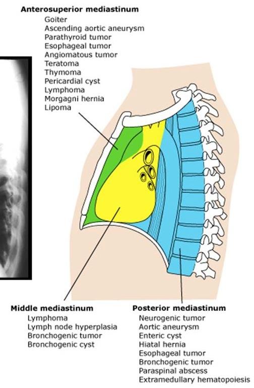 Mediastinal Compartments Superior - Thoracic inlet to sternal angle Inferior: - Anterior - Sternum to