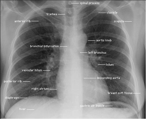 brachiocephalic arteries & veins, phrenic nerves, trachea, main bronchi, main PA - Posterior -