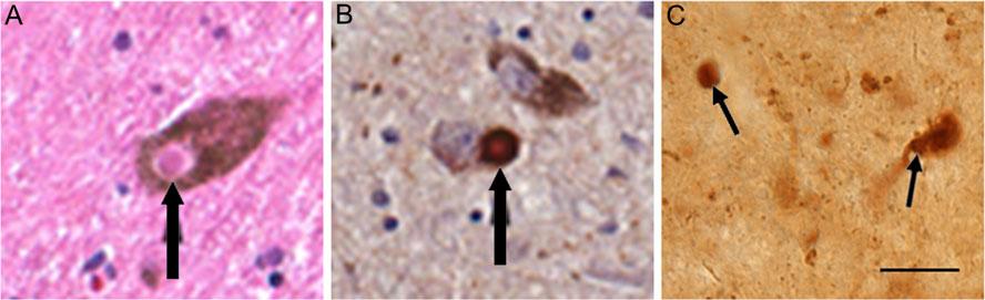 302 M.-F. Chesselet et al Fig. 5 Alpha-synuclein pathology in human (A, B) and mouse (C) substantia nigra neurons.