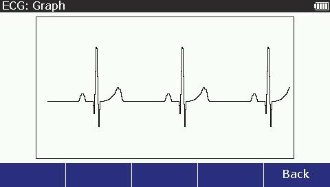 Vital Signs Simulator ECG Function 3. Push or to adjust the deviation. Each push of a key moves the deviation 0.05 or 0.1 mv in the direction of the key pushed. The deviation range is ±0.