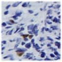 immunohistochemistry of CD3 cell infiltrates into
