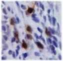 cells in pancreatic tumors from PC mice treated with