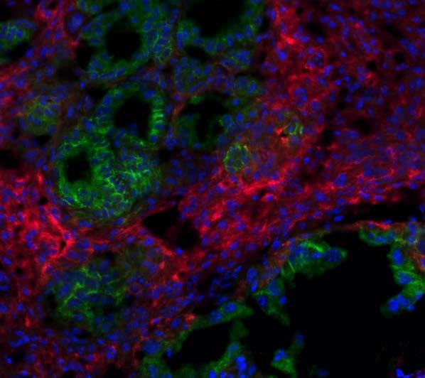 Images showing immunofluorescence staining of FAP + cancer associated fibroblasts (red), EpCAM + tumor cells (green), and