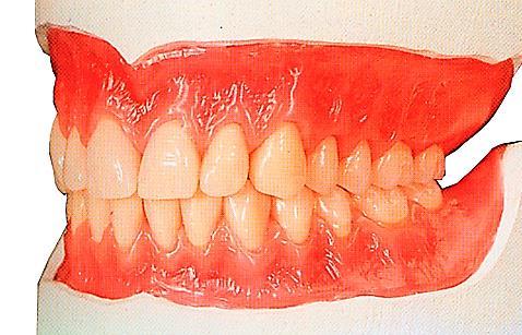 The gingival area should be sculptured to create as an aesthetic and natural situation as possible. The upper waxed denture pattern should have the uniform thickness throughout.