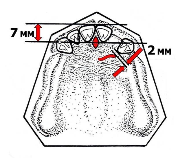 recommendations artificial central incisors should be placed anteriorly to incisal papillae at a distance of 7 mm (Fig. 3, fig. 4). The main landmarks for the canine positioning are palatine rugae.