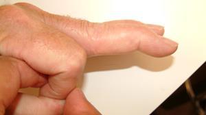 Swan-Neck Deformity Introduction Normal finger position and movement occur from the balanced actions of many important structures. Ligaments support the finger joints.