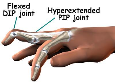 In the PIP joint (the middle joint between the main knuckle and the DIP joint), the strongest ligament is the volar plate.