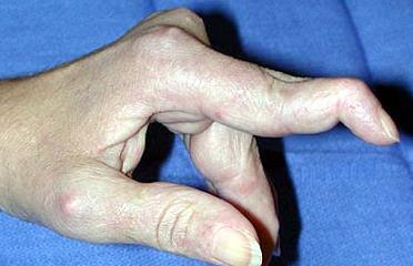 Inflammation from injury or disease (such as RA) may cause pain and swelling of the PIP