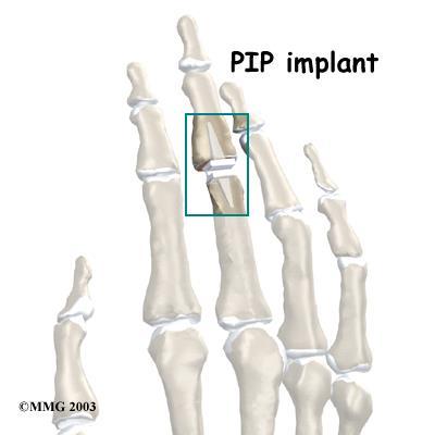 PIP Joint Arthroplasty Swan neck deformity with a stiff PIP joint sometimes requires replacement of the PIP joint, called arthroplasty.