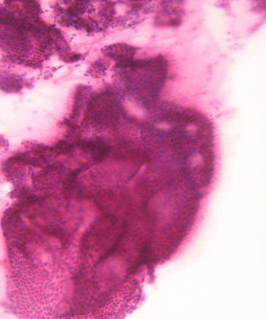 Invasive Non invasive (Cysto) adenoma Cytological findings Abundant mucin Variable cellularity Sheets, papillary groups, and single cells
