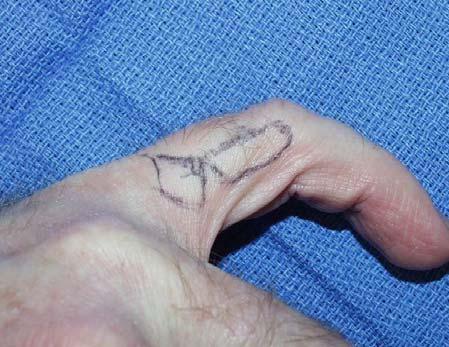 Angulation or phalangeal shortening: Extensor mechanism over proximal and