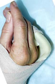 Operative fractures: Phalangeal fractures that