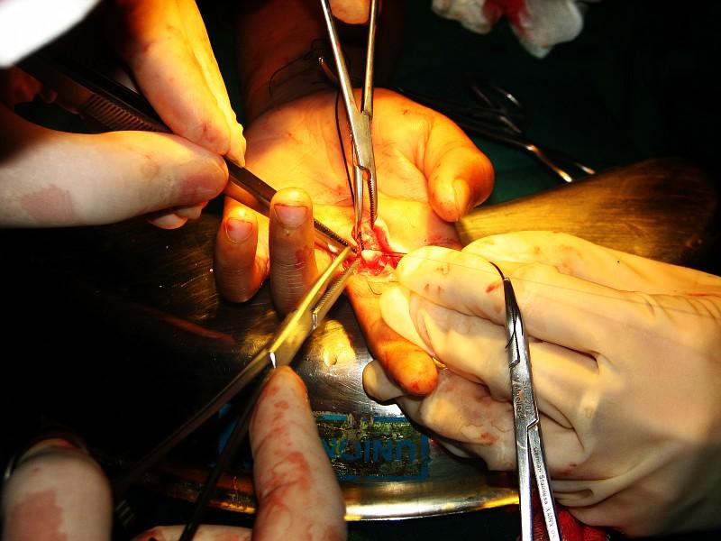 JERSEY FINGER Surgical Repair Always Required Delay in Treatment More Than 7 Days Makes Primary Repair Difficult Delay