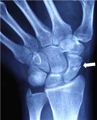 SCAPHOID FRACTURES Fall on