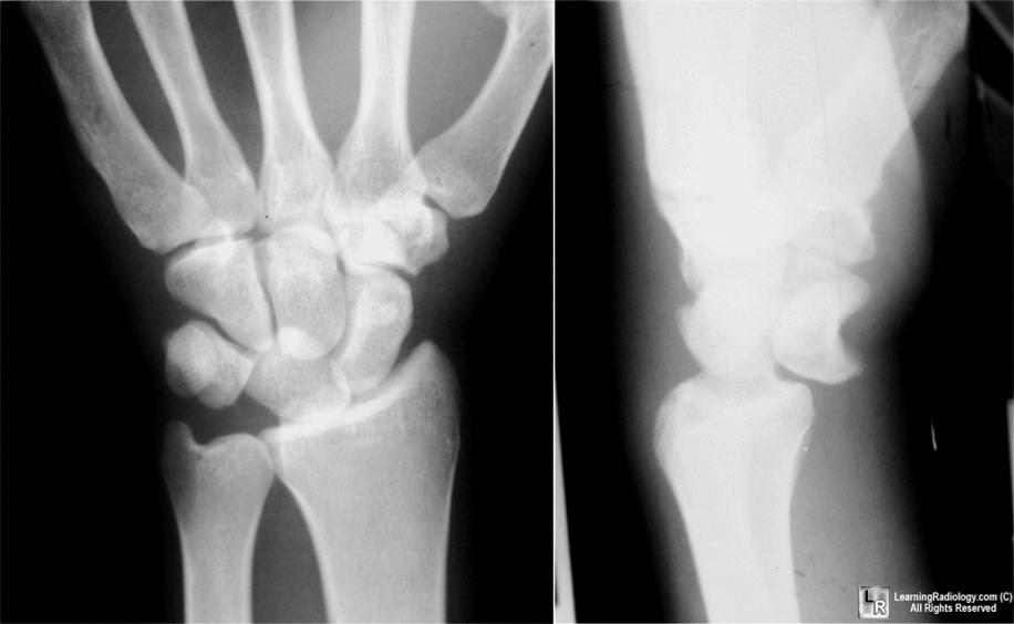 PERILUNATE DISLOCATIONS In spectrum of injury of scaphoid fracture and scapholunate