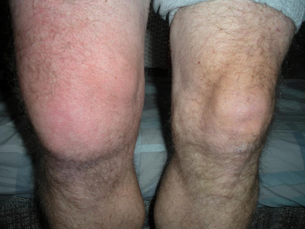 6. Acute Knee Swelling