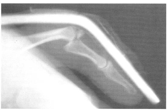 PIP Joint Dislocations X-rays needed to