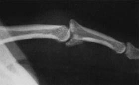 dislocations that result in a fracture