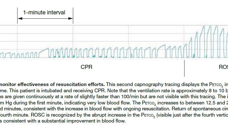etco 2 During CPR Onset of arrest etco 2 Decreases During CPR etco 2 Increases Slightly ROSC etco 2 Markedly Increases ROSC (cont d) etco 2 Falls Slightly CPR and ROSC Reprinted with permission.
