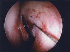 2 of 6 11/3/2008 2:21 PM Fig 1: Uncinatomy incision Fig 2: Uncinatomy Fig 3: Uncinatomy Fig