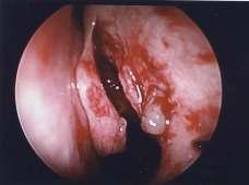 This exposes the base of the infundibulum, anterior ethmoid sinus, bullae ethmoidalis and