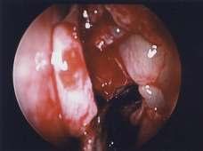 Fig 5: Palpating the maxillary ostium We prefer to identify the maxillary sinus ostium