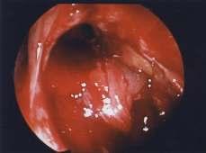 middle turbinate. These cells are opened and frontonasal recess is exposed and unblocked by removing the disease mucosa.
