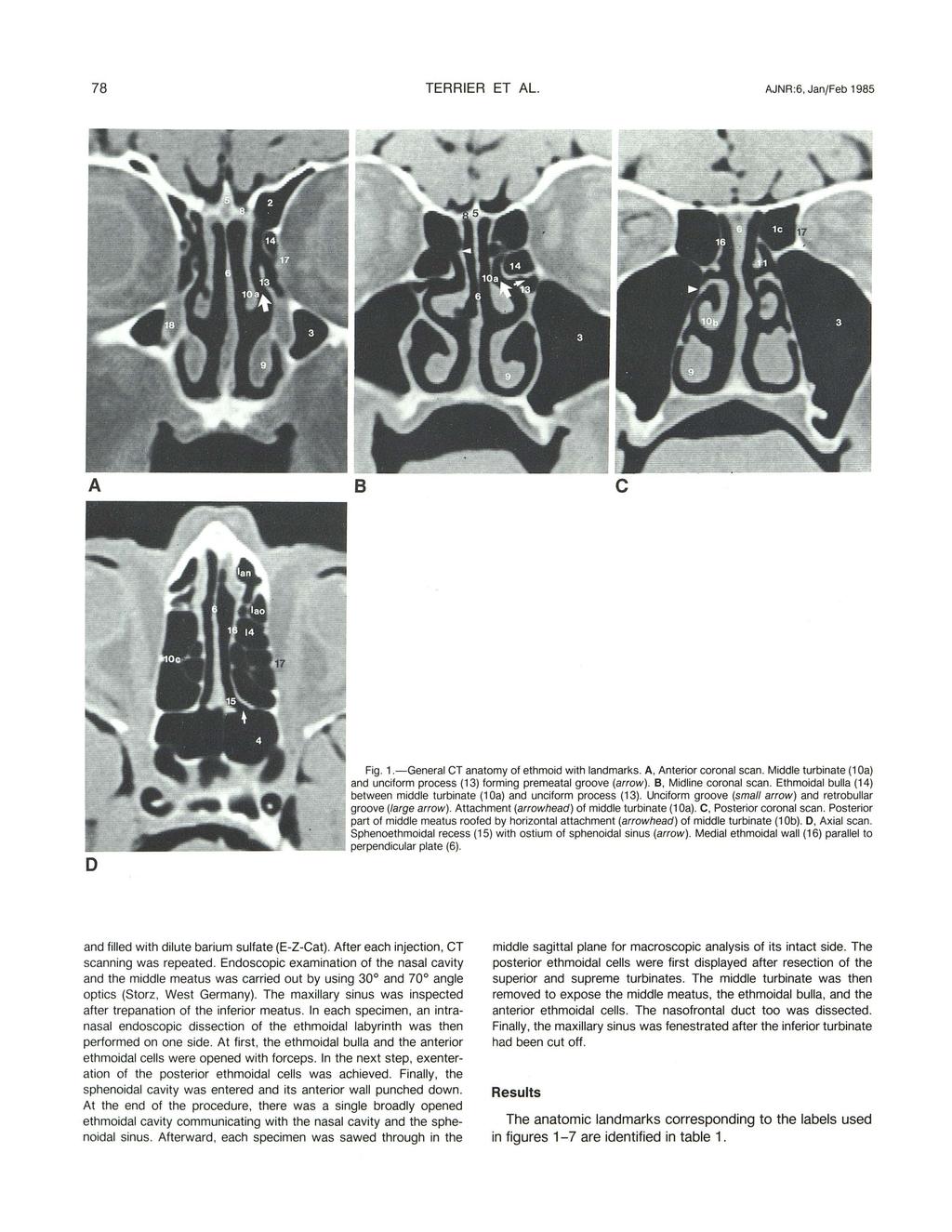 78 TERRIER ET AL. AJNR :6, Jan/Feb 1985 A 8 c o Fig. 1.-General CT anatomy of ethmoid with landmarks. A, Anterior coronal scan.