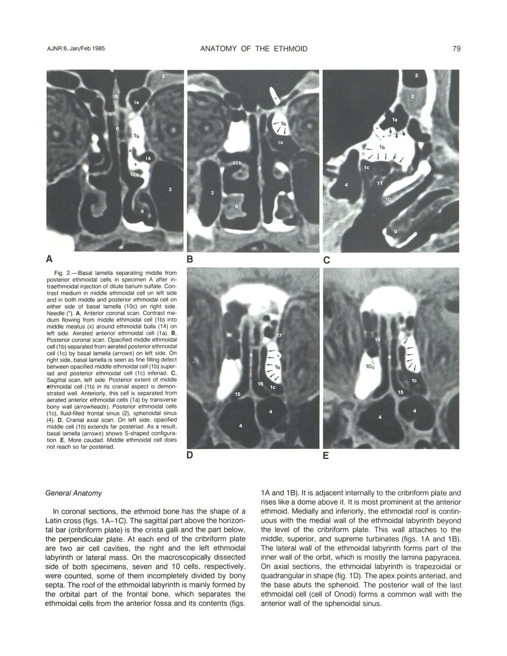 AJNR :6, Jan/Feb 1985 ANATOMY OF THE ETHMOID 79 A Fig. 2.- 8asal lamella separating middle from posterior ethmoidal cells in specimen A after intraethmoidal injection of dilute barium sulfate.