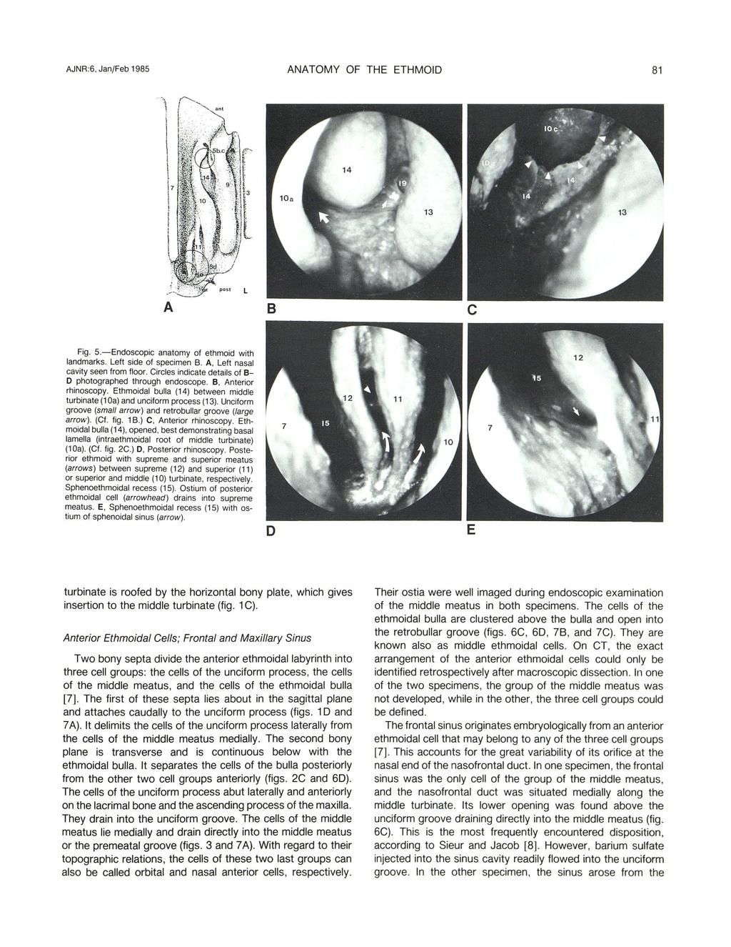 AJNR :6, Jan/Feb 1985 ANATOMY OF THE ETHMOID 81 A Fig. 5.-Endoscopic anatomy of ethmoid with landmarks. Left side of specimen B. A, Left nasal cavity seen from floor.