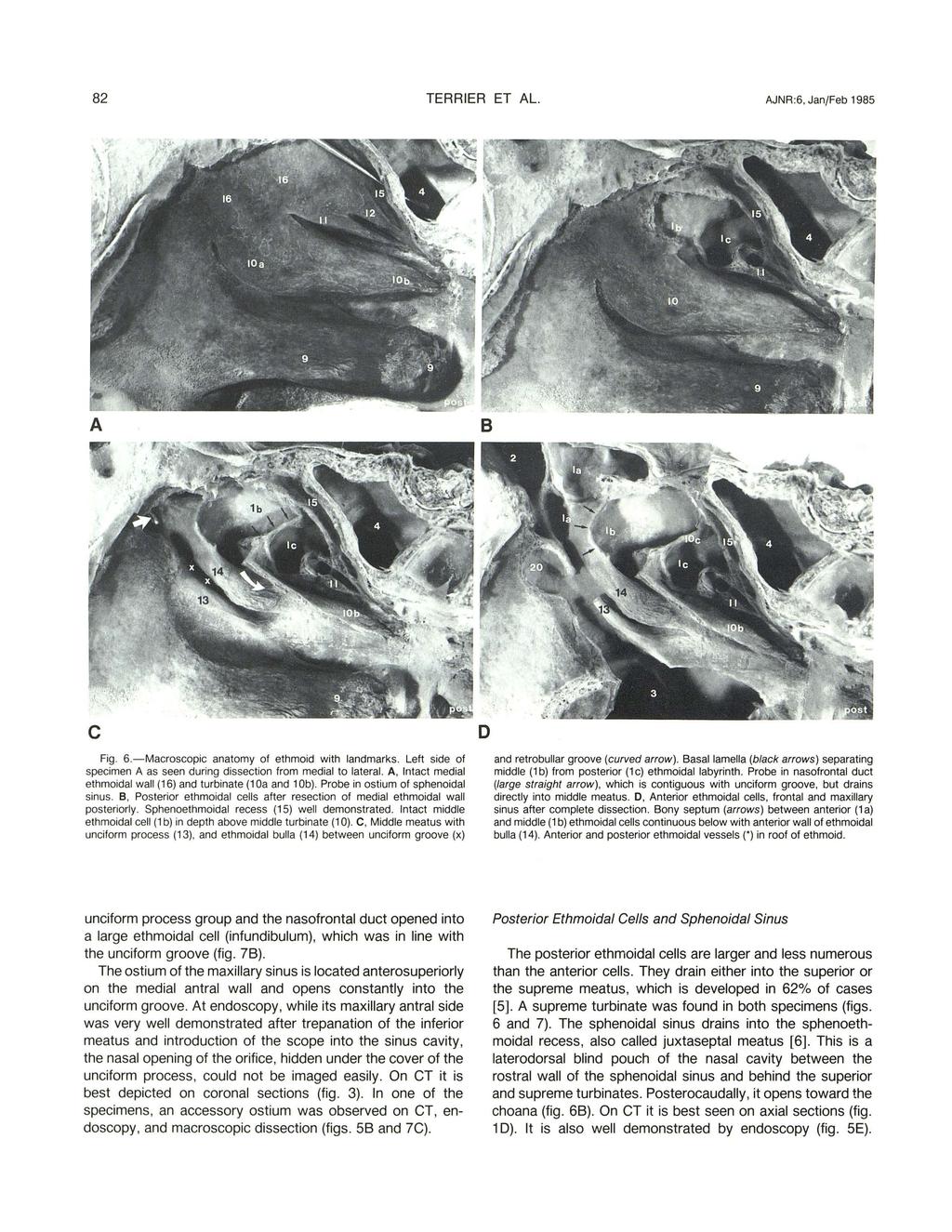 82 TERRIER ET AL. AJNR:6, Jan/Feb 1985 A 8 c Fig. 6.-Macroscopic anatomy of ethmoid with landmarks. Left side of specimen A as seen during dissection from medial to lateral.