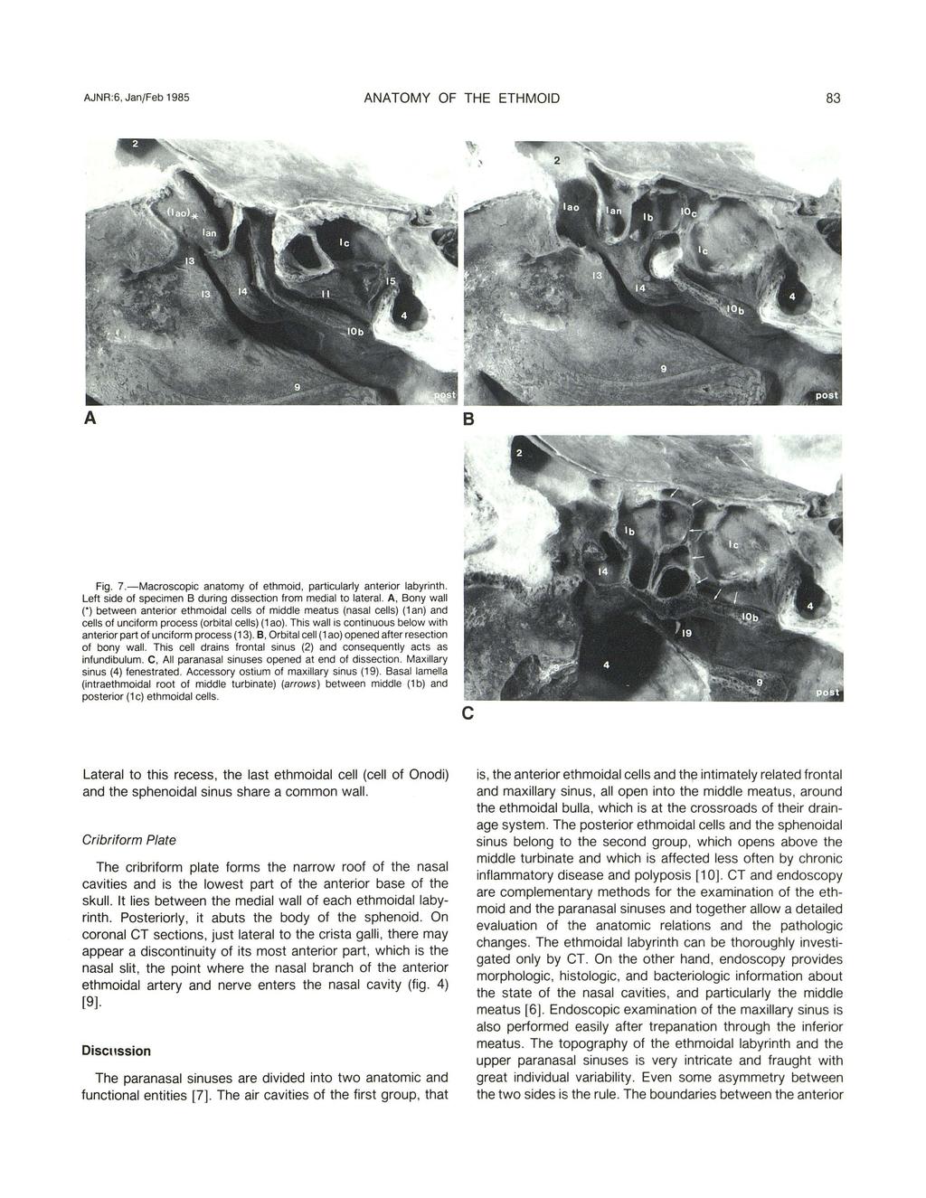 AJNR :6, Jan/Feb 1985 ANATOMY OF THE ETHMOID 83 A B Fig. 7.-Macroscopic anatomy of ethmoid, particularly anterior labyrinth. Left side of specimen B during dissection from medial to lateral.