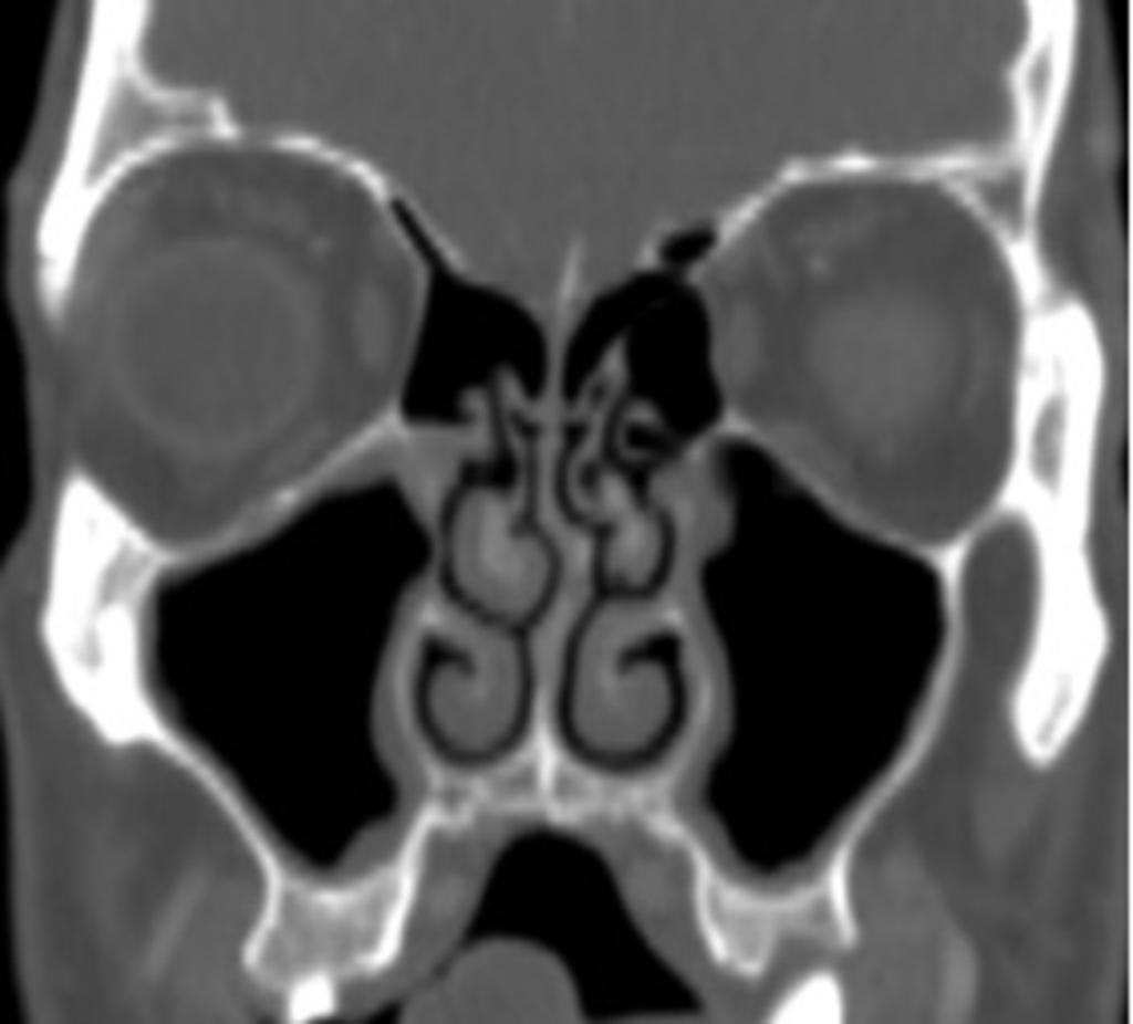 Fig. 4: Coronal reformatted CT image shows paradoxical