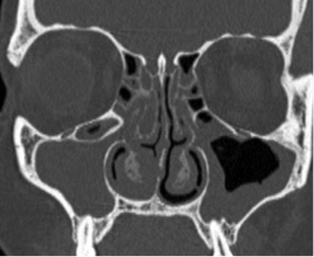 Fig. 8: Coronal reformatted CT image
