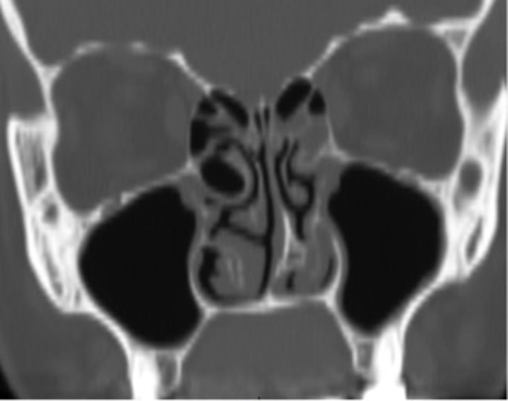 Fig. 9: Coronal reformatted CT image
