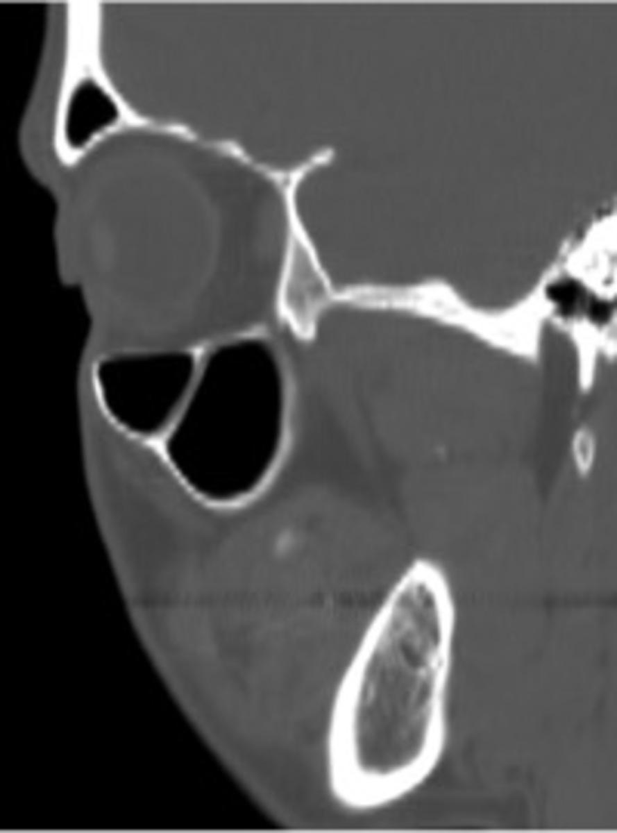 Fig. 10: Sagittal reformatted CT image