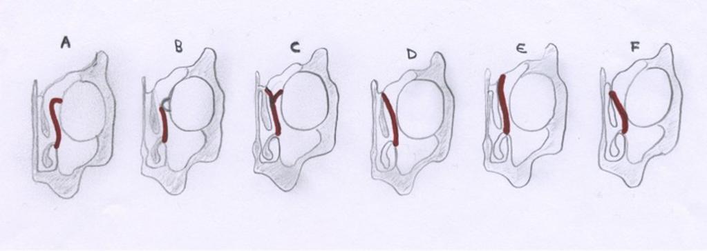 Fig. 12: Fig 5. Landsberg & Friedman classification of superior uncinate process insertion. A: Type 1, insertion into the lamina papyracea.