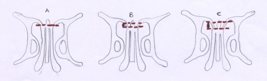 Fig. 14: Sphenoid pneumatization: A. conchal, B. presellar, C. sellar, D.