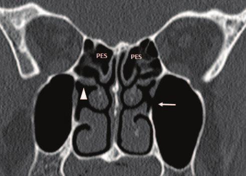 16 Paranasal Sinuses 4.4. Anatomical variations of maxillary sinus Accessory sinus ostium: Any maxillary sinus opening outside the hiatus semilunaris is considered an accessory ostium.