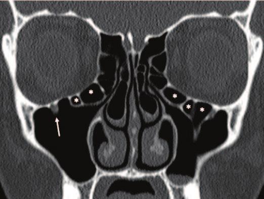 Paranasal Sinus Anatomy: What the Surgeon Needs to Know http://dx.doi.org/10.5772/intechopen.69089 17 Figure 11.