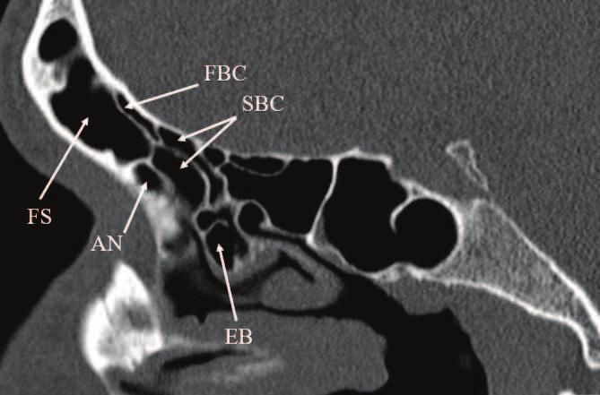Figure 22. Coronal CT scan showing frontal intersinus septal air cell (asterisk). Note the frontal cell type 3 on the right frontal sinus (FC3).