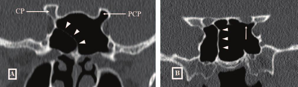 (A) Conchal, when not reaching the vertical level of the anterior wall of sella turcica. (B) Presellar, when reaches but not beyond it.