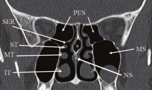 32 Paranasal Sinuses The sphenoid intersinus septum occasionally deviates of the midline and has an insertion on the internal carotid artery bony canal or the optic canal.