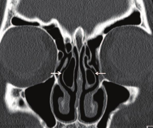 Paranasal Sinus Anatomy: What the Surgeon Needs to Know http://dx.doi.org/10.5772/intechopen.