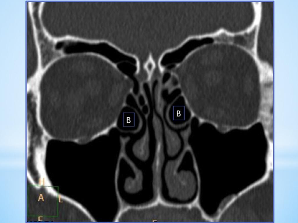 Fig. 4: Coronal NECT shows