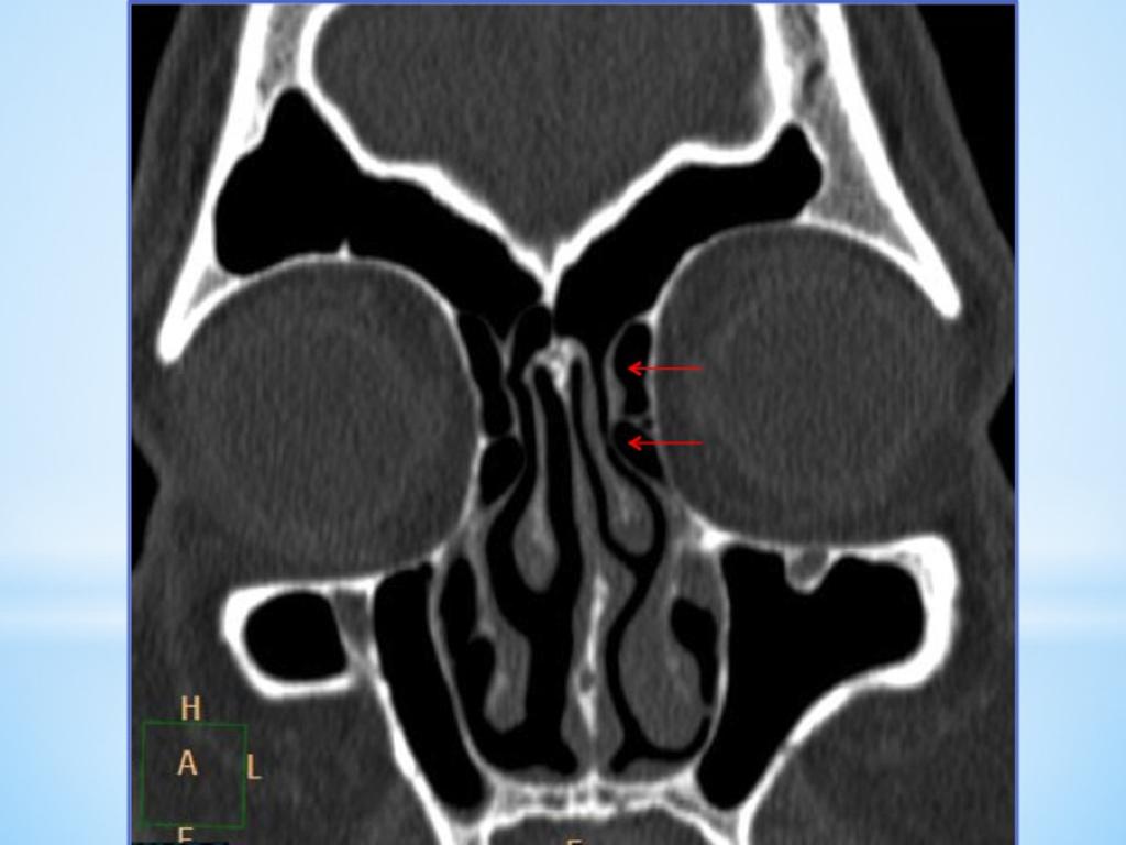 Fig. 5: Coronal CT shows left side